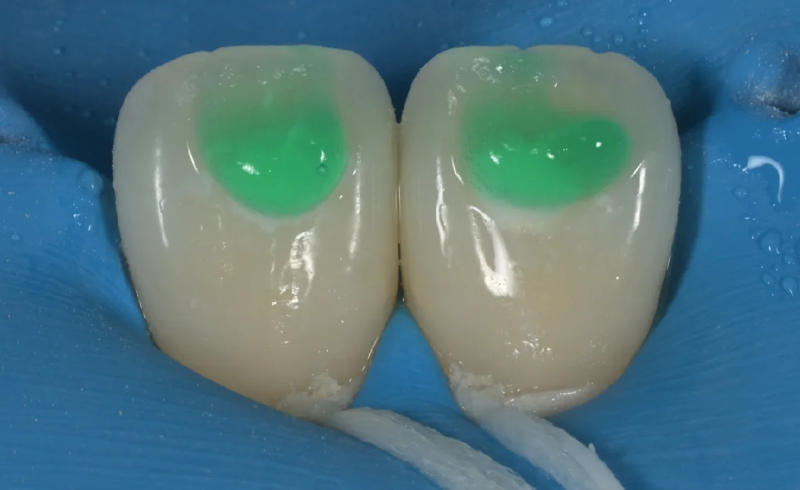 ICON治療。｜坂寄歯科医院（取手市藤代） - 画像4