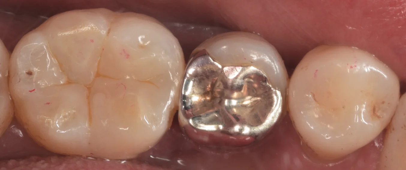 古い金属にできた虫歯をその日のうちに白い詰め物で。｜坂寄歯科医院（取手市藤代） - 画像4