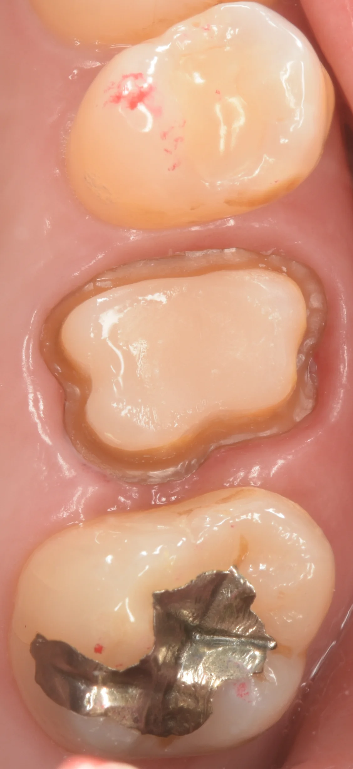 セラミックの被せ物｜坂寄歯科医院（取手市藤代） - 画像3