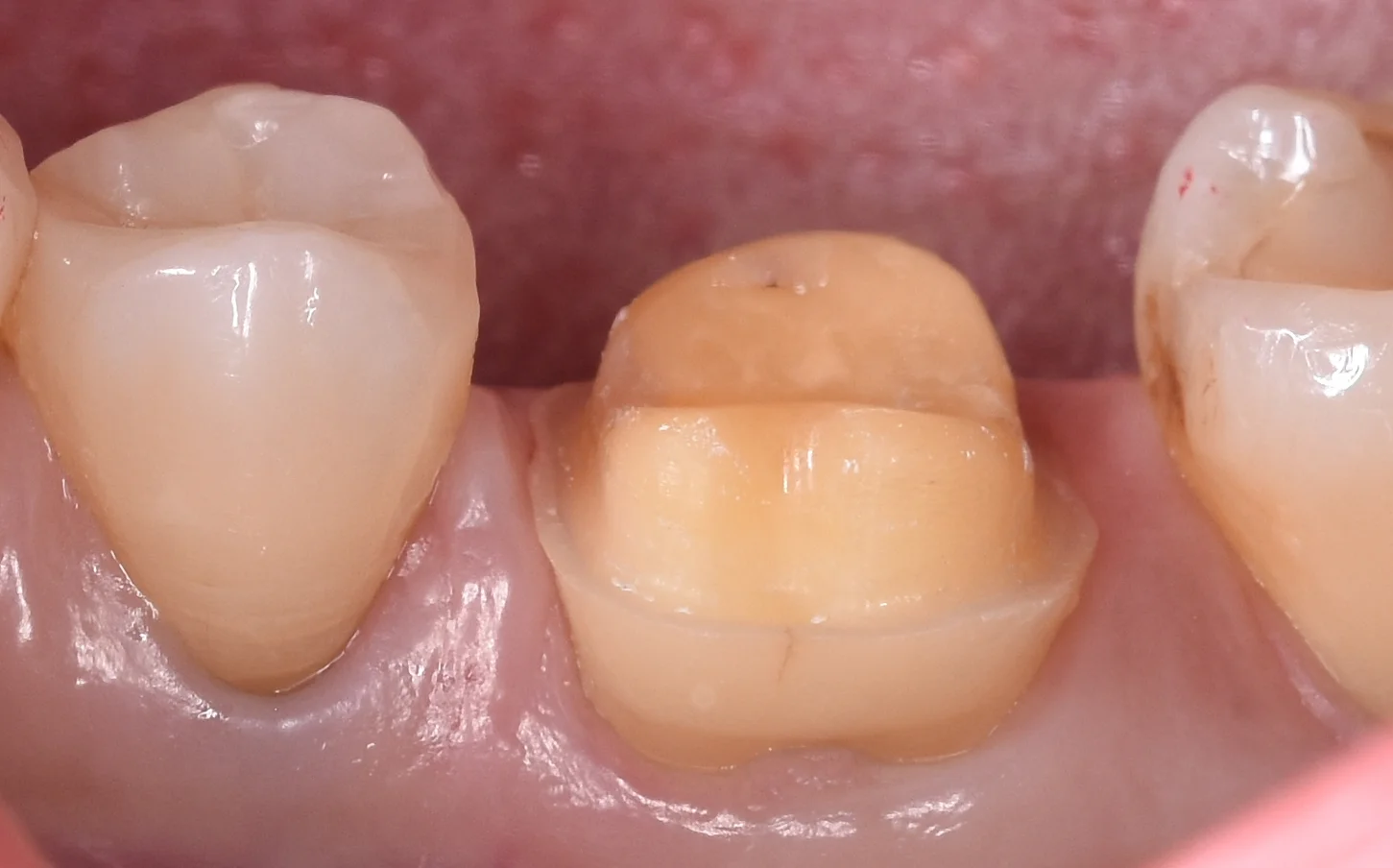 歯の亀裂で痛みが出たため、被せ物に。｜坂寄歯科医院（取手市藤代） - 画像2