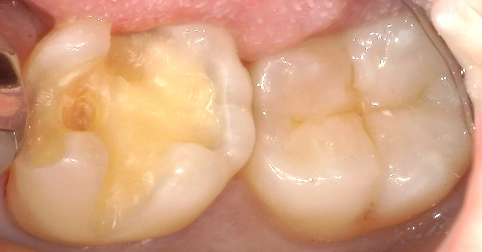 奥歯の自費の白い詰め物。術後数週間後もあります。｜坂寄歯科医院（取手市藤代） - 画像3