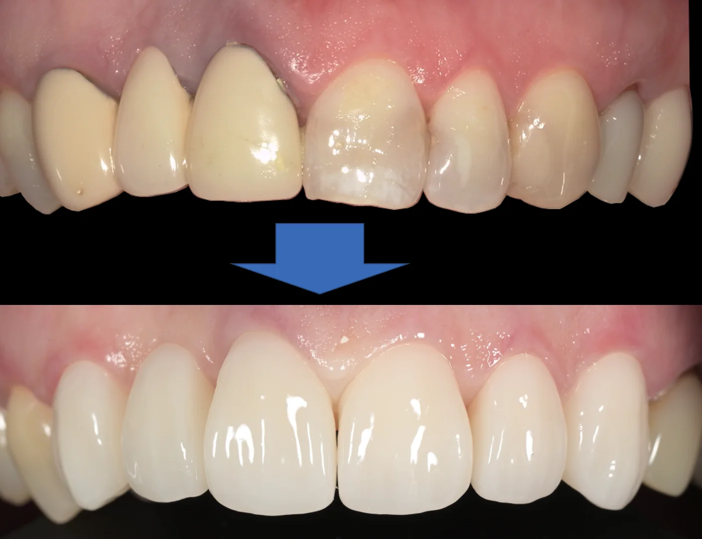 審美治療：セラミック｜坂寄歯科医院（取手市藤代） - 画像6
