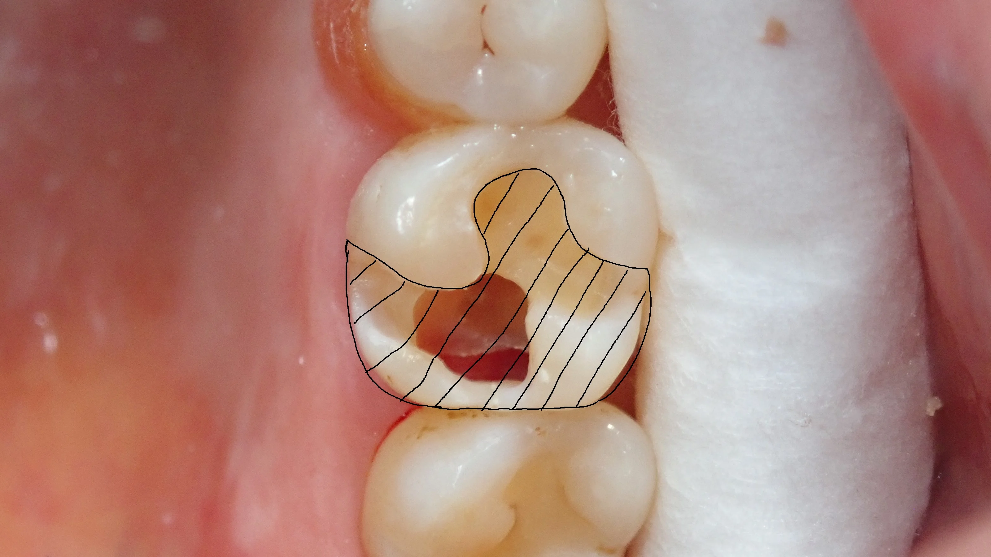 ダイレクトボンディング③(臼歯)|坂寄歯科医院(取手市藤代) - 画像3