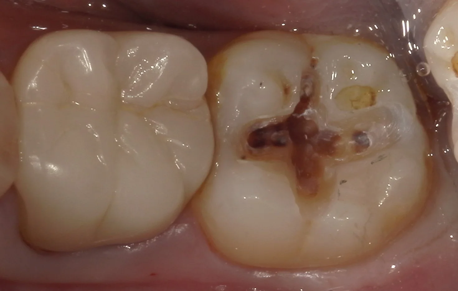 遠方より虫歯の治療で通院された方を一日で治療しました。｜坂寄歯科医院（取手市藤代） - 画像2