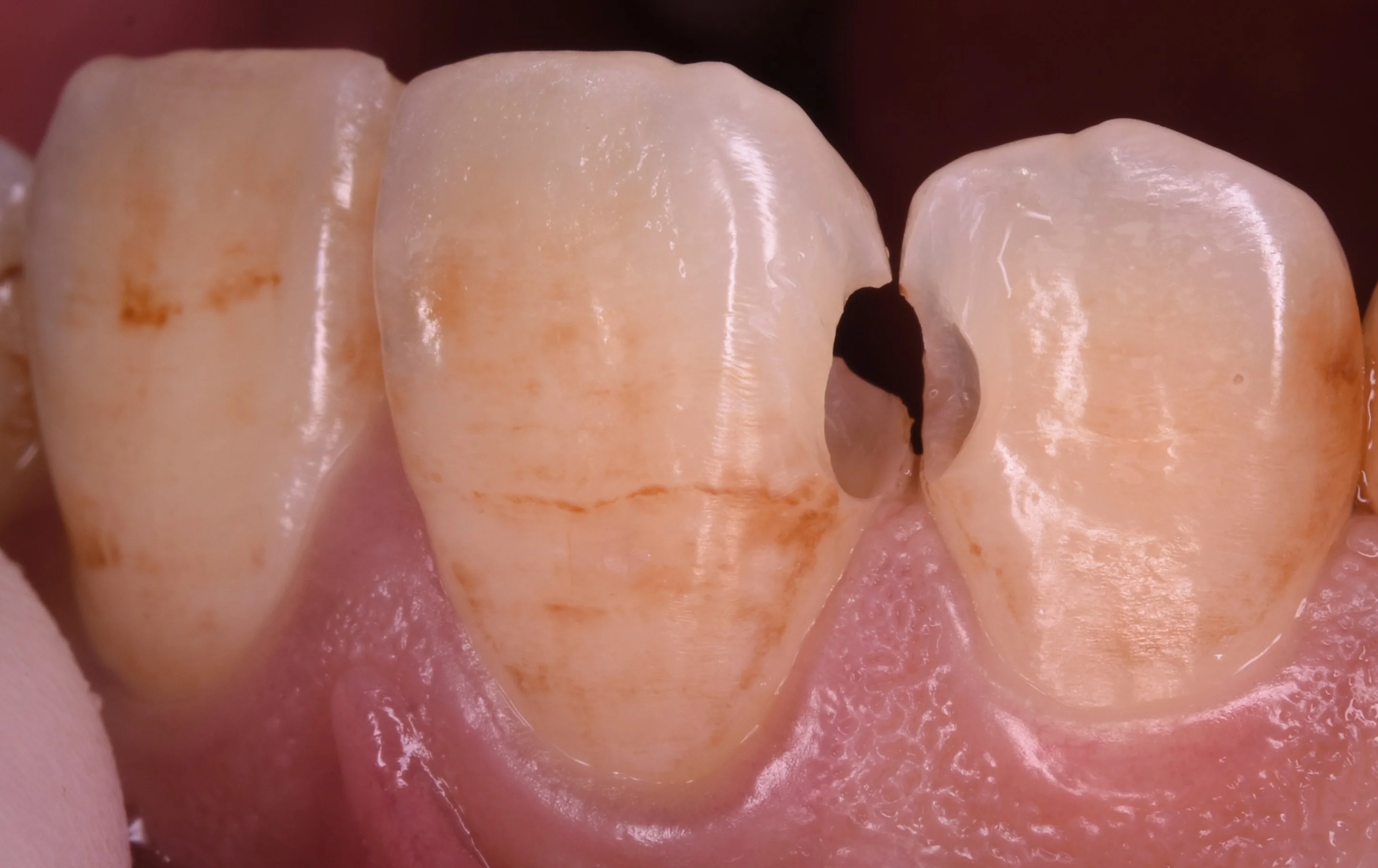 前歯の虫歯の治療で可能な限り歯を温存したケース。|坂寄歯科医院(取手市藤代) - 画像3