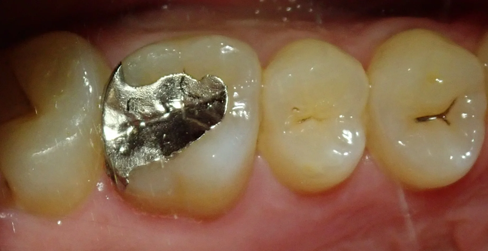 ブログ・お役立ち情報｜坂寄歯科医院（取手市藤代）