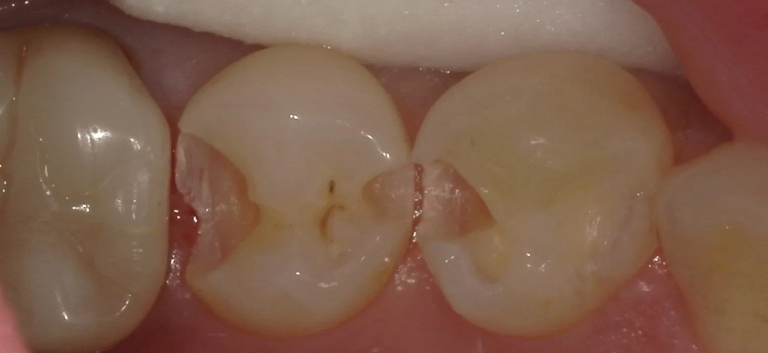 右下奥歯を纏めて治療。遠方からの通院。|坂寄歯科医院(取手市藤代) - 画像3