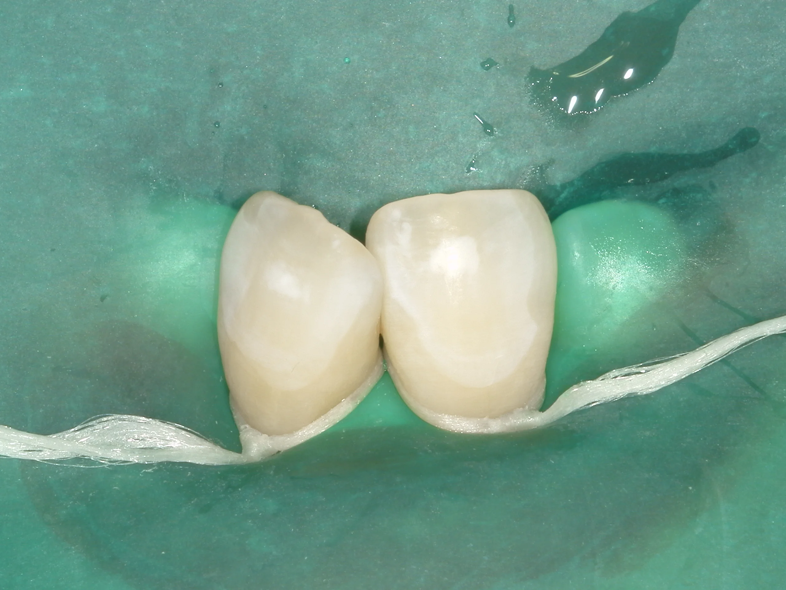 ICON治療(低侵襲ホワイトスポット改善治療)を始めました。|坂寄歯科医院(取手市藤代) - 画像4