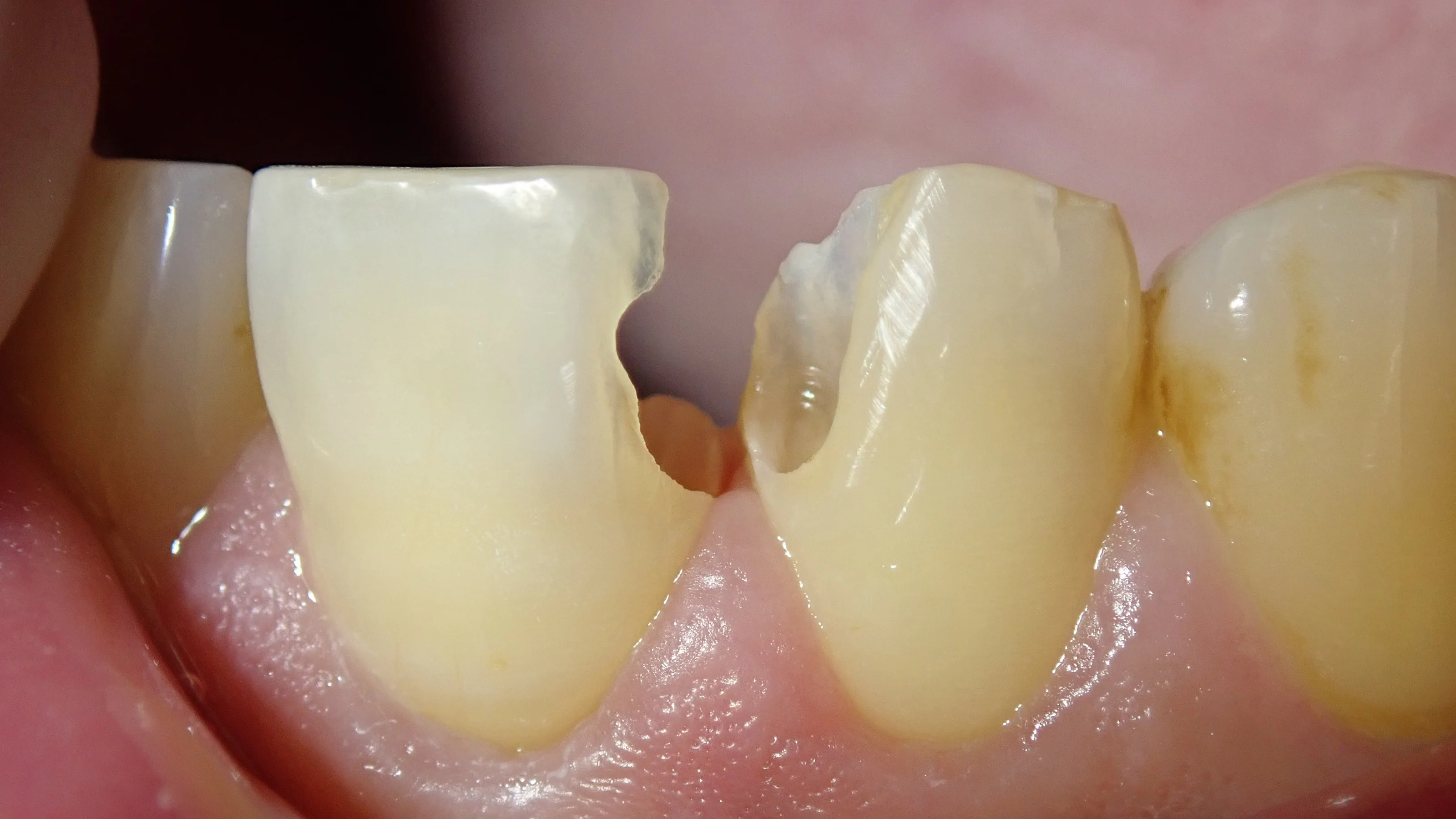 前歯の白い詰め物｜坂寄歯科医院（取手市藤代） - 画像5