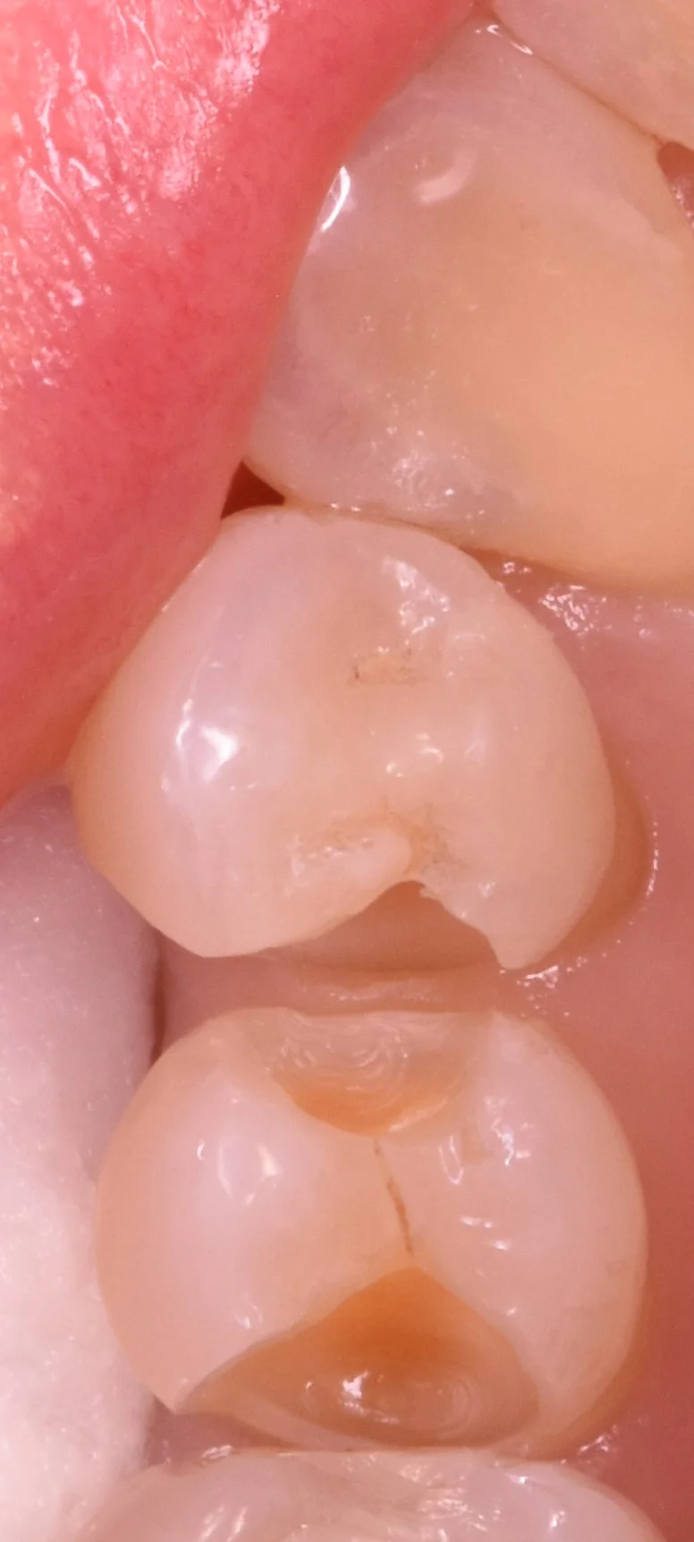 奥歯の歯並びが悪くなってしまっている所の治療｜坂寄歯科医院（取手市藤代） - 画像3