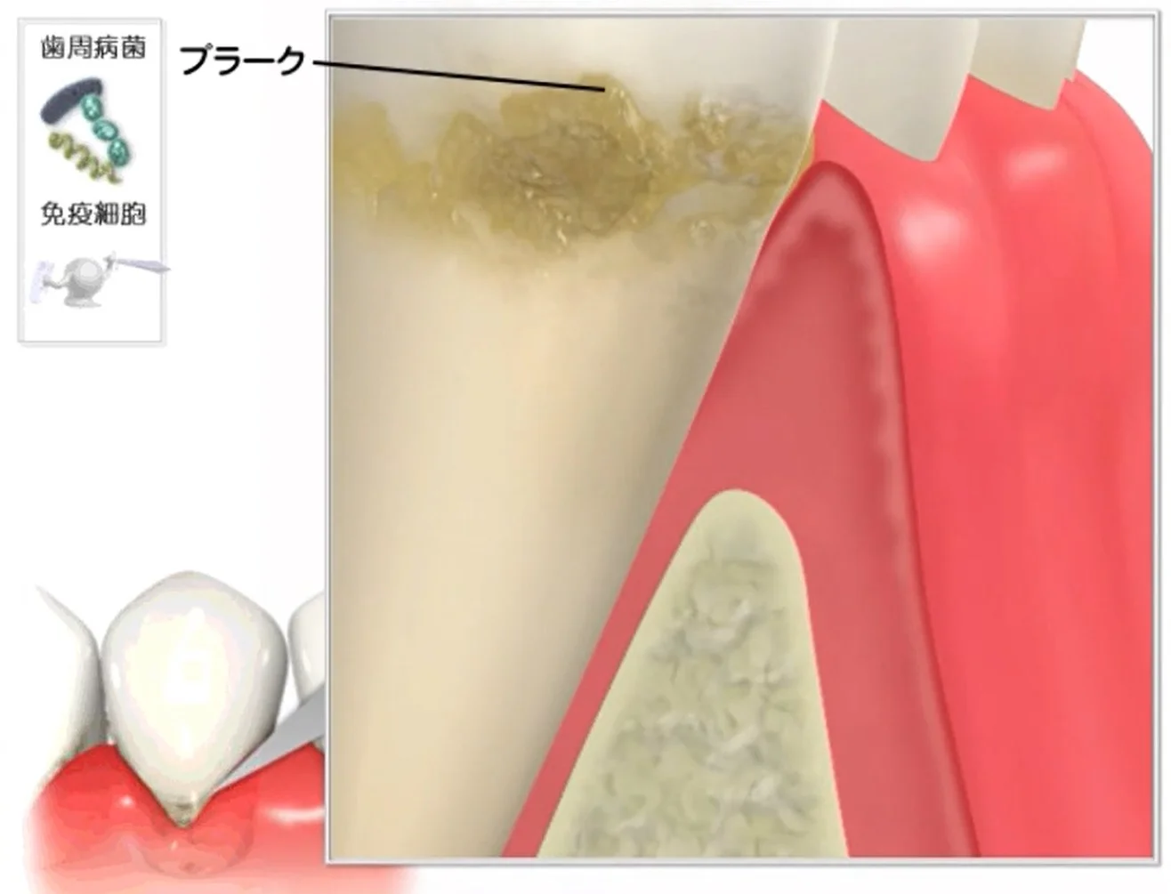 歯にプラーク（バイオフィルム）が付着した状態の断面図