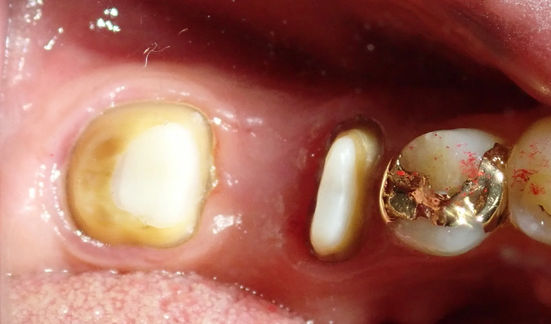 その抜歯ちょっと待って!|坂寄歯科医院(取手市藤代) - 画像6