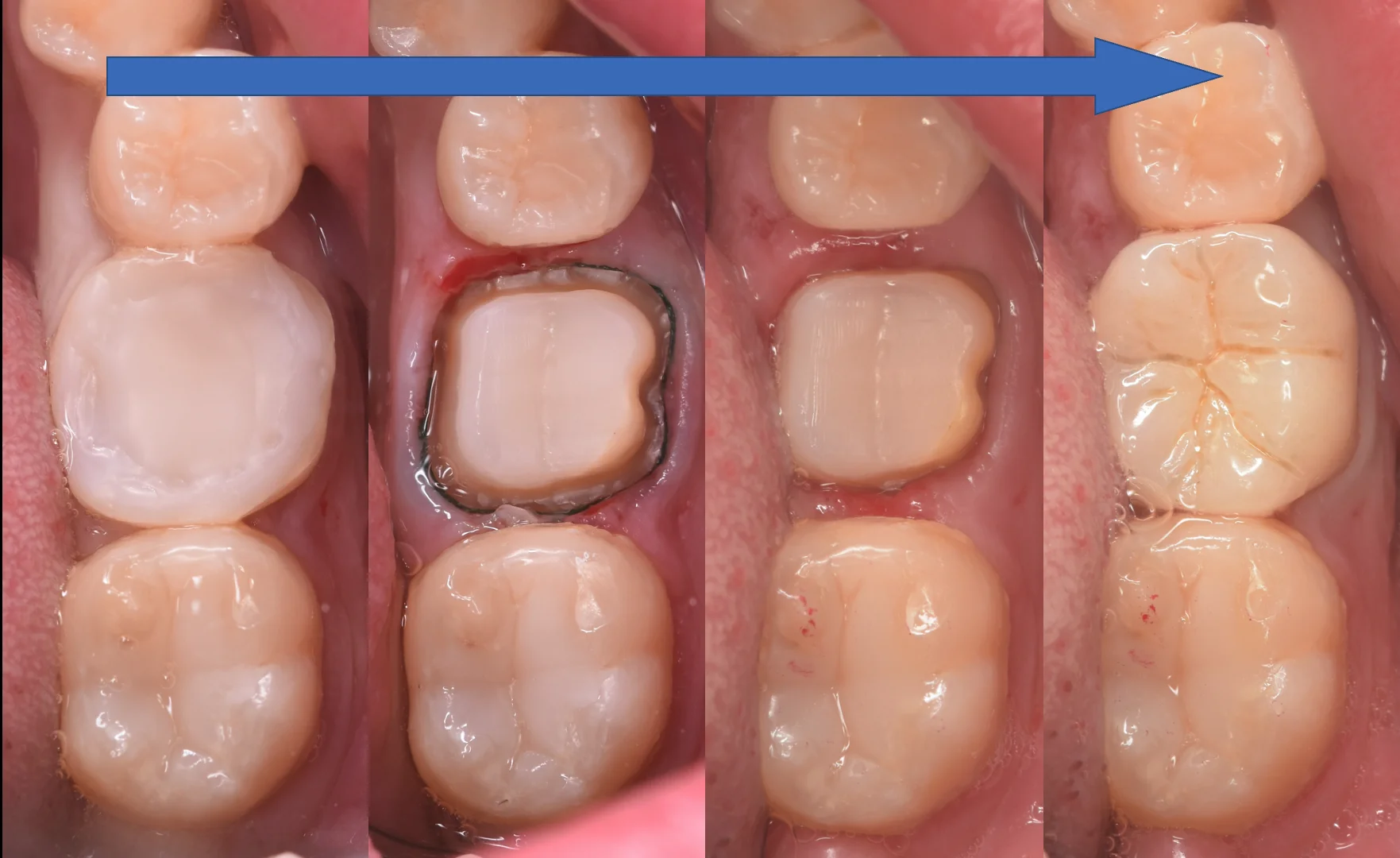 セラミックの被せ物｜坂寄歯科医院（取手市藤代） - 画像6