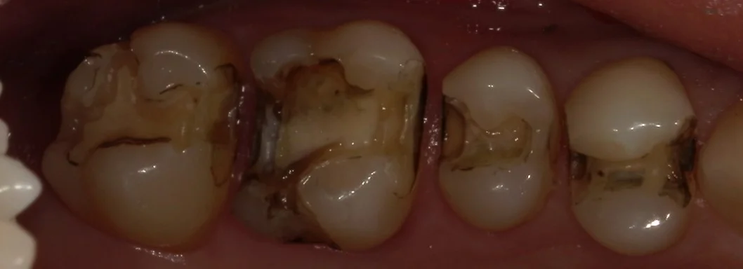 全体的に金属を白い詰め物に。｜坂寄歯科医院（取手市藤代） - 画像2