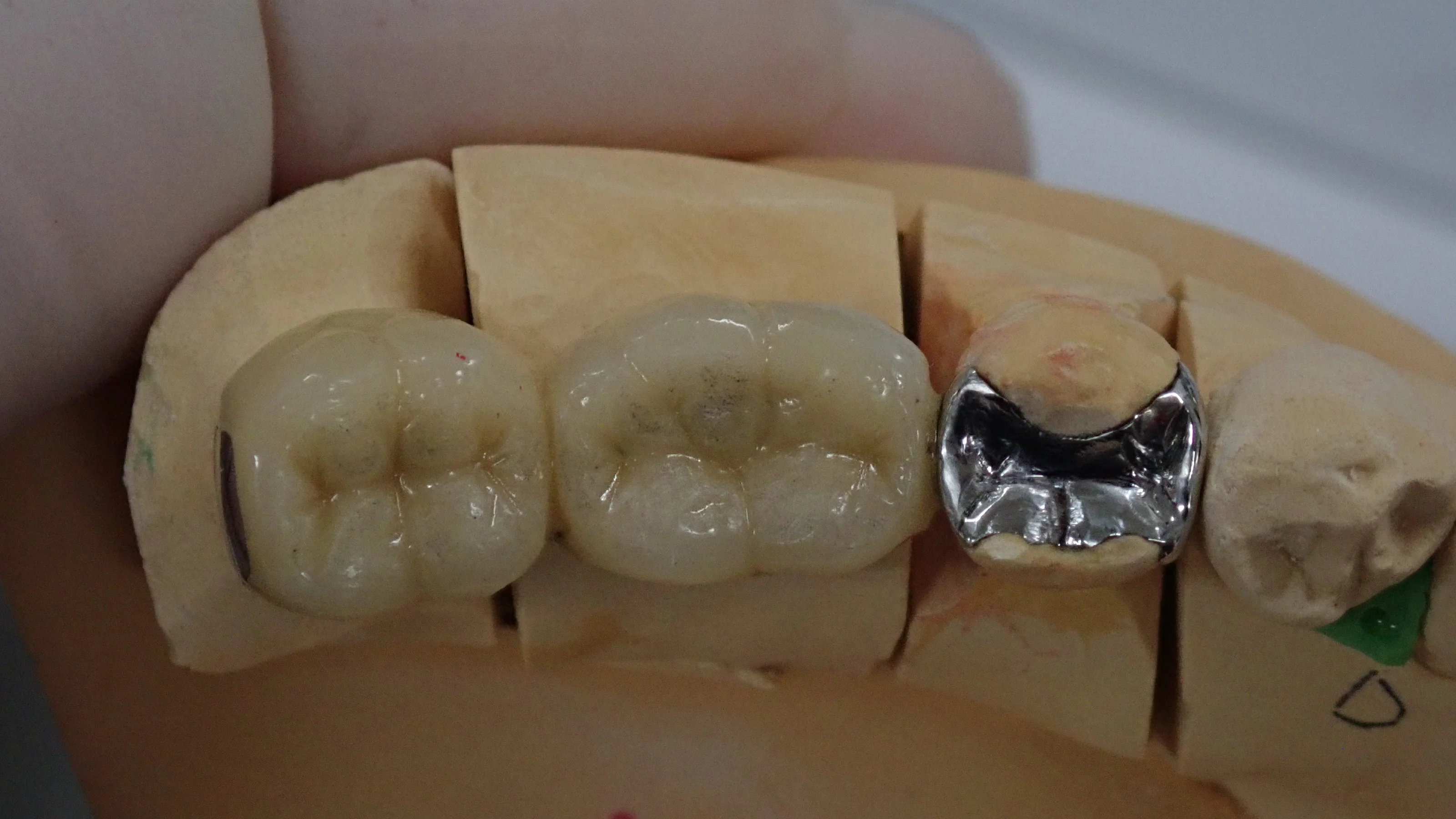 歯を可及的に温存したブリッジ｜坂寄歯科医院（取手市藤代） - 画像5