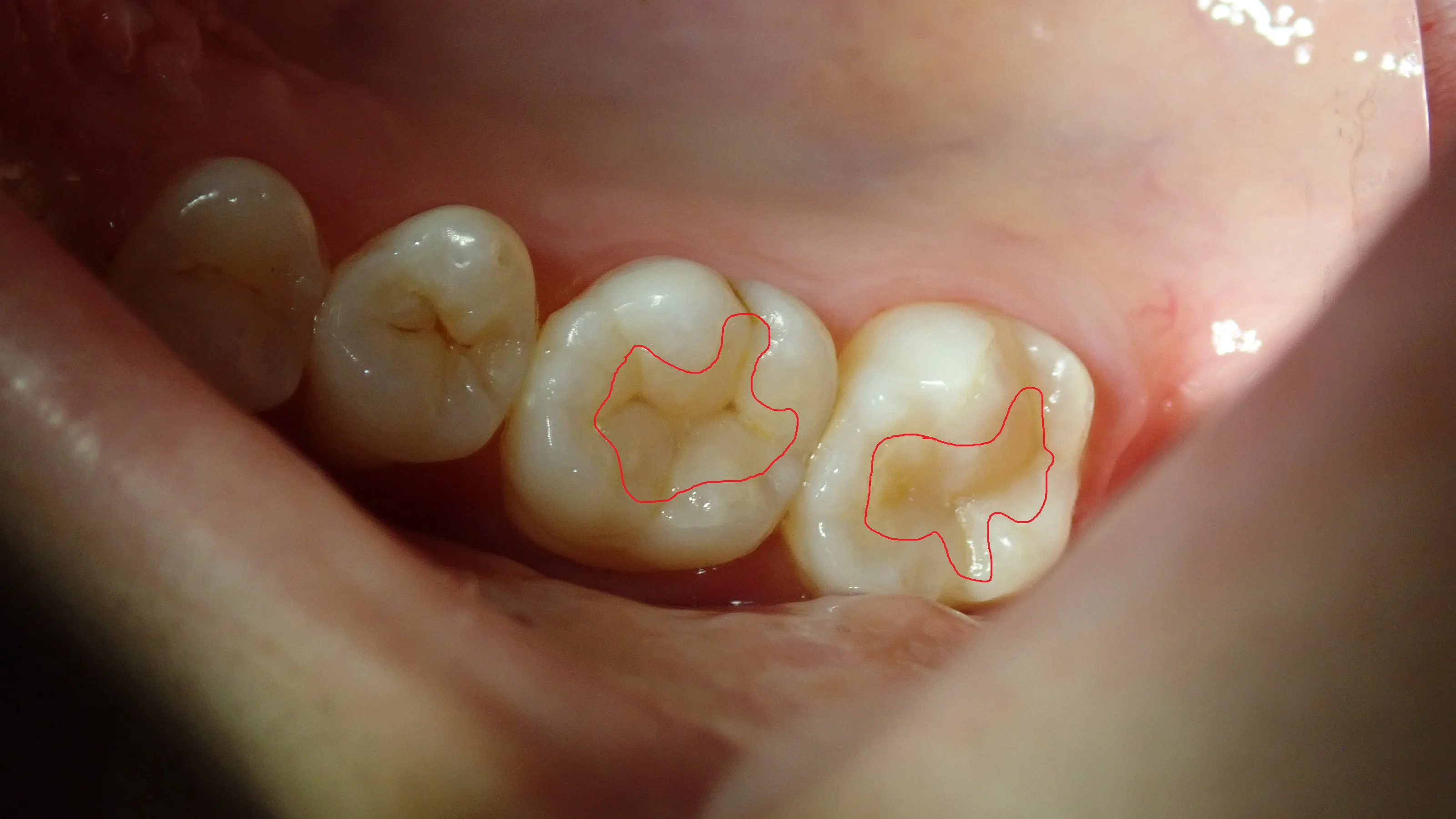 ダイレクトボンディング(処置後3年経過)｜坂寄歯科医院（取手市藤代） - 画像2