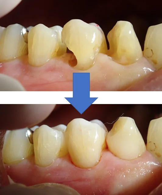 3本連続ダイレクトボンディング｜坂寄歯科医院（取手市藤代） - 画像5