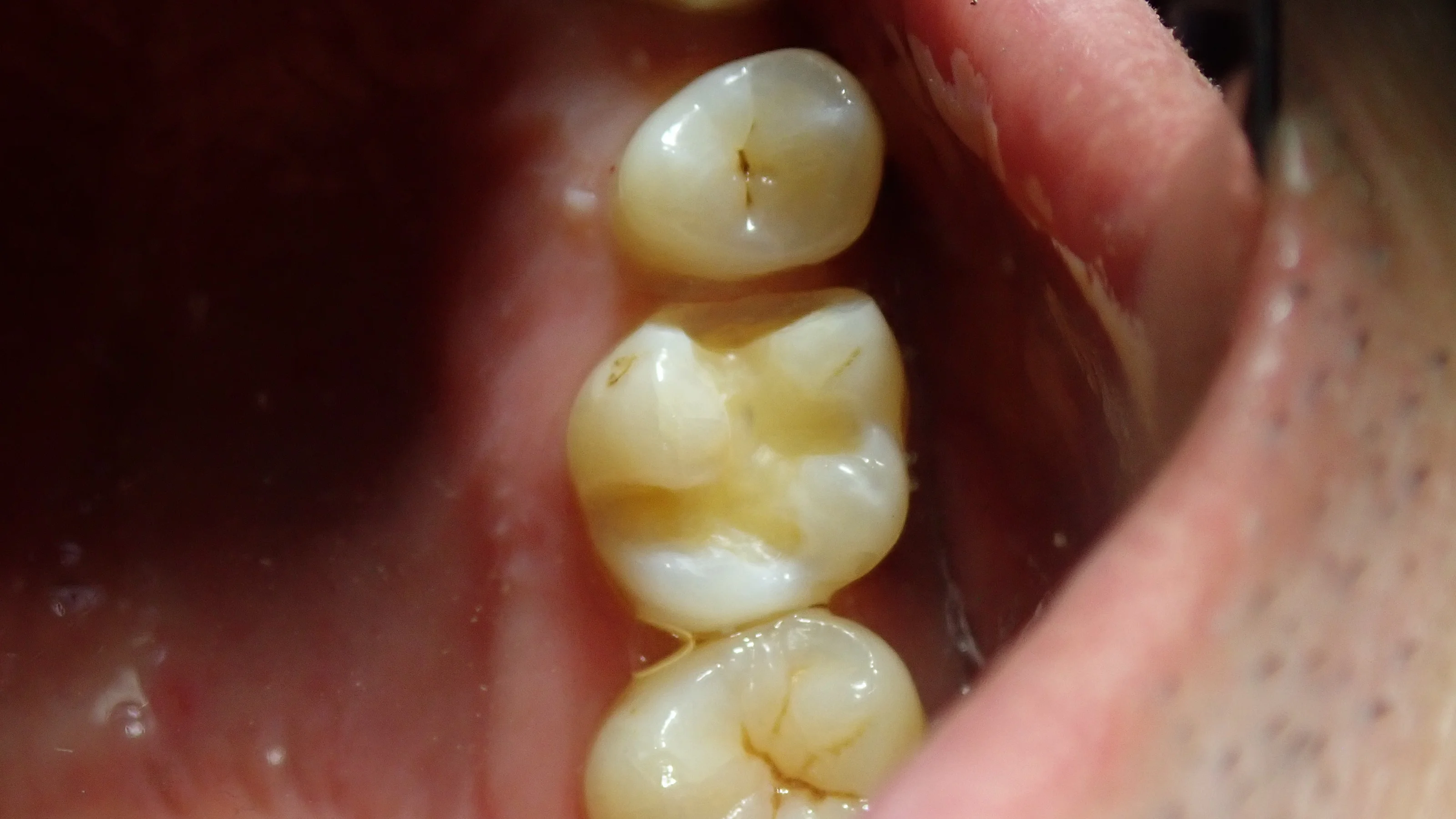 ダイレクトボンディング⑨｜坂寄歯科医院（取手市藤代） - 画像2