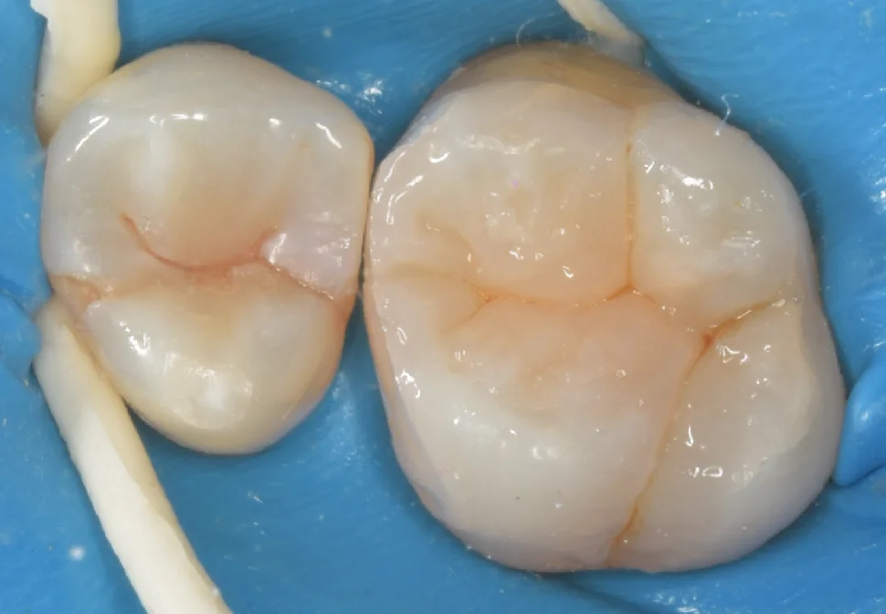 金属の詰め物を白い歯に。｜坂寄歯科医院（取手市藤代） - 画像3