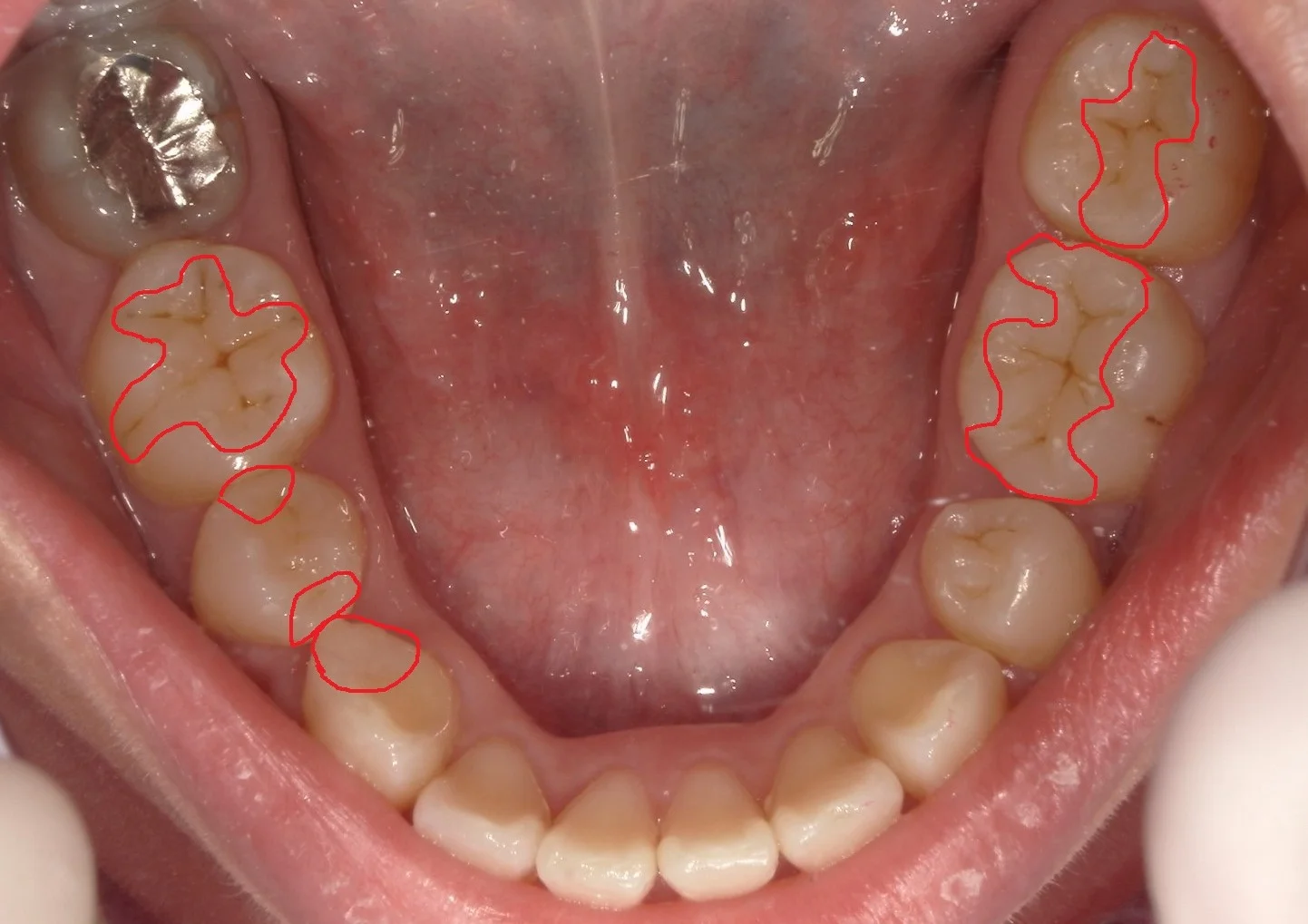 全顎的に白い詰め物で治した症例｜坂寄歯科医院（取手市藤代） - 画像4