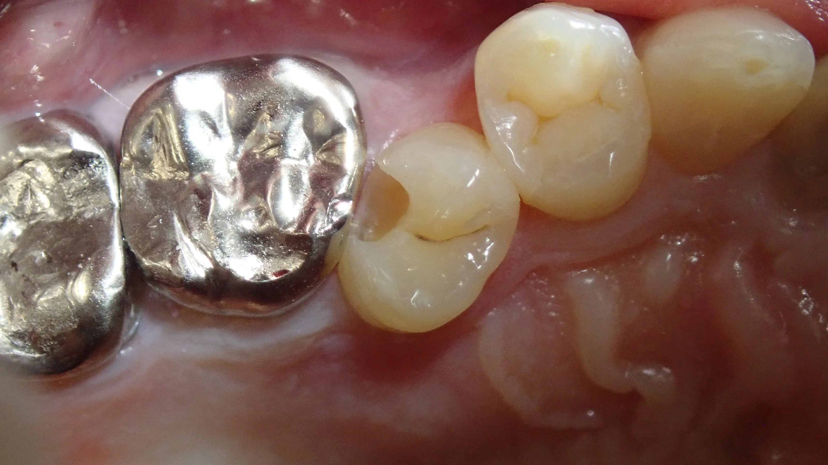 左上3本まとめてダイレクトボンディング|坂寄歯科医院(取手市藤代) - 画像6