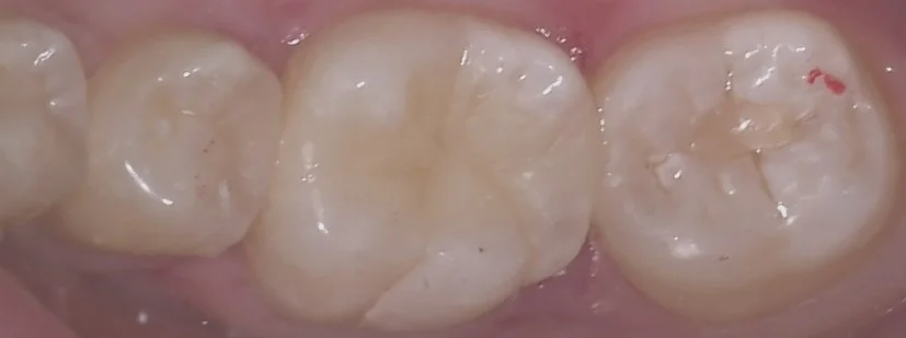 複数本を一気に治療。｜坂寄歯科医院（取手市藤代） - 画像3