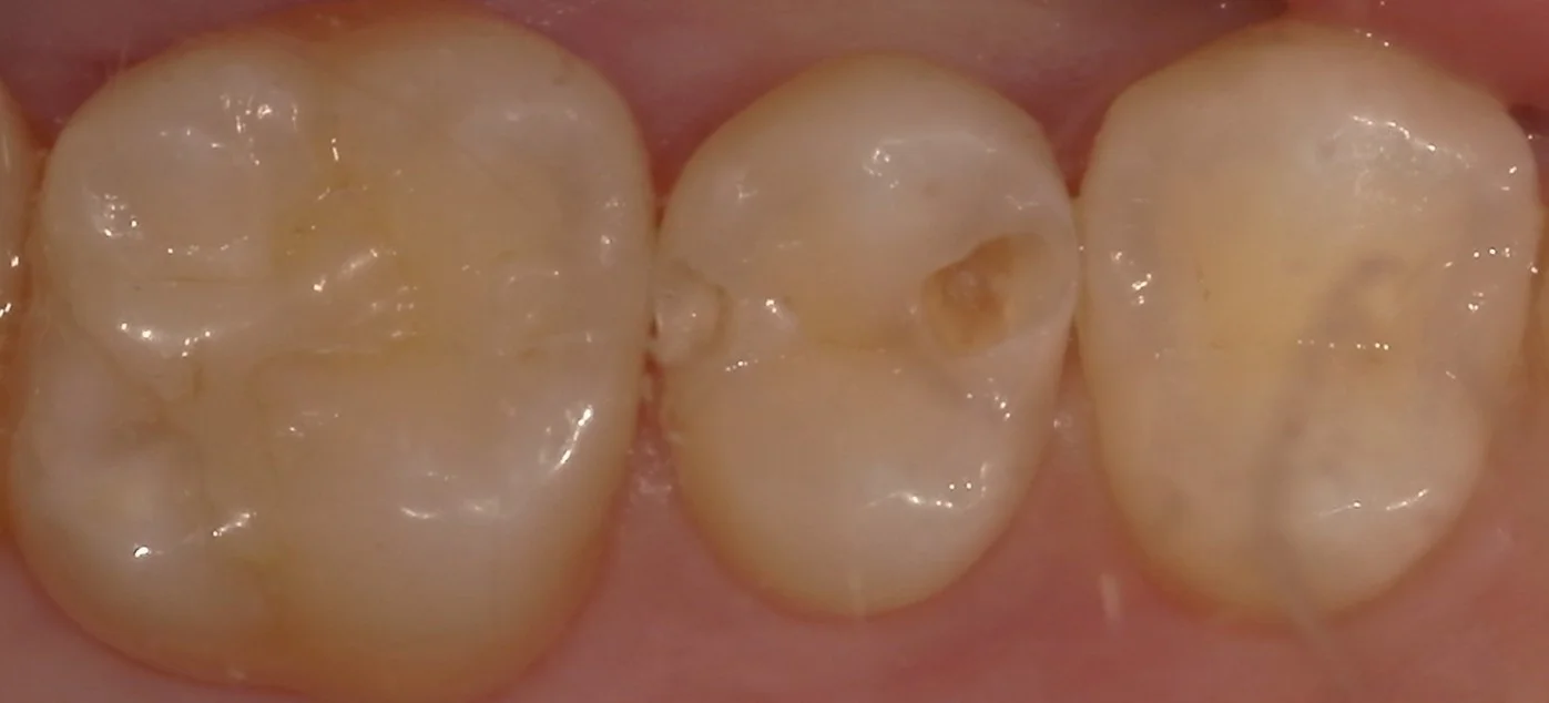 遠方から白い詰め物での治療を求めて・・・｜坂寄歯科医院（取手市藤代） - 画像3