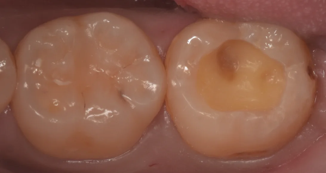 鎌倉からダイレクトボンディングを希望して｜坂寄歯科医院（取手市藤代） - 画像2