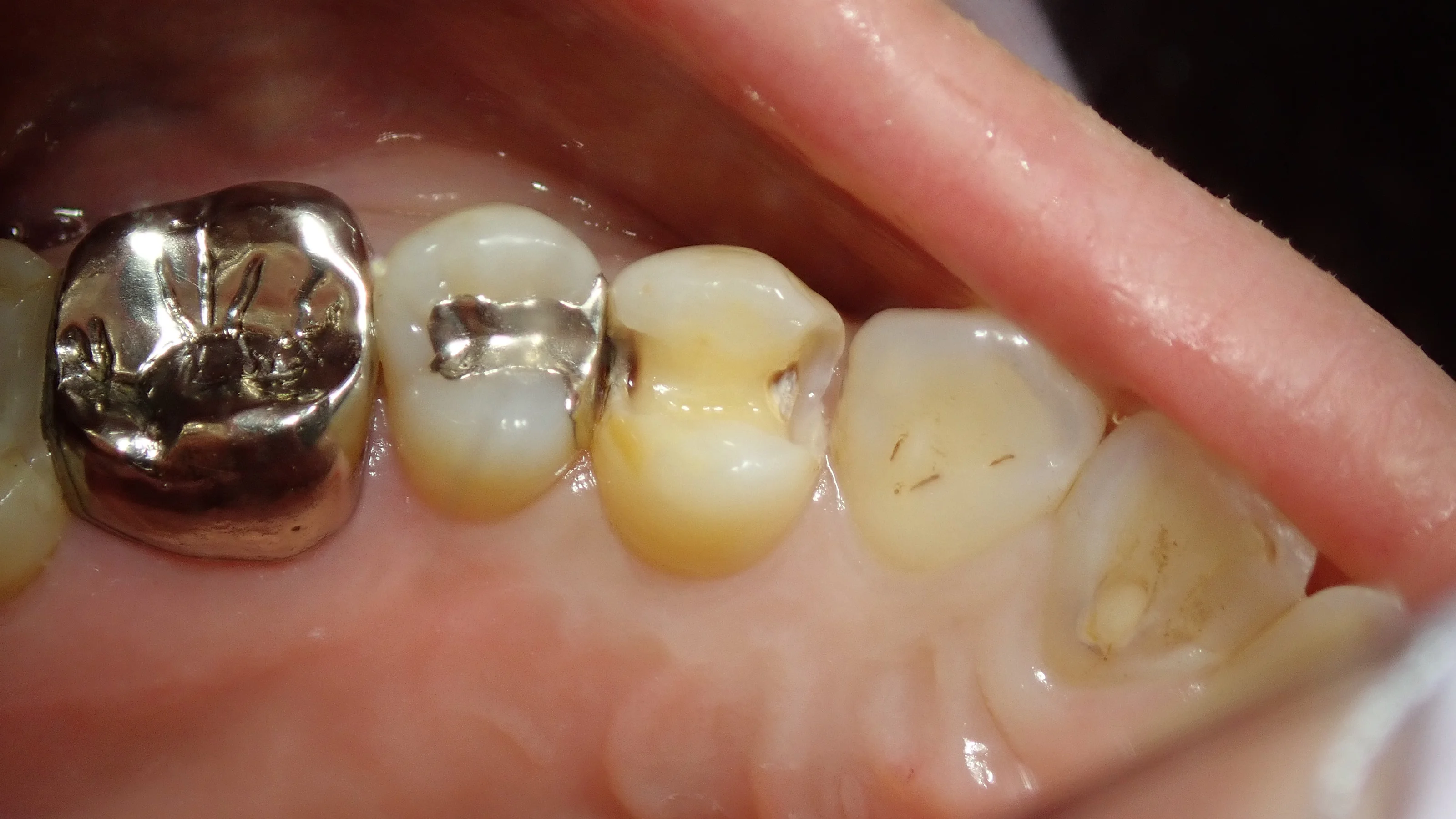 小さい奥歯(小臼歯)の白い詰め物｜坂寄歯科医院（取手市藤代） - 画像4