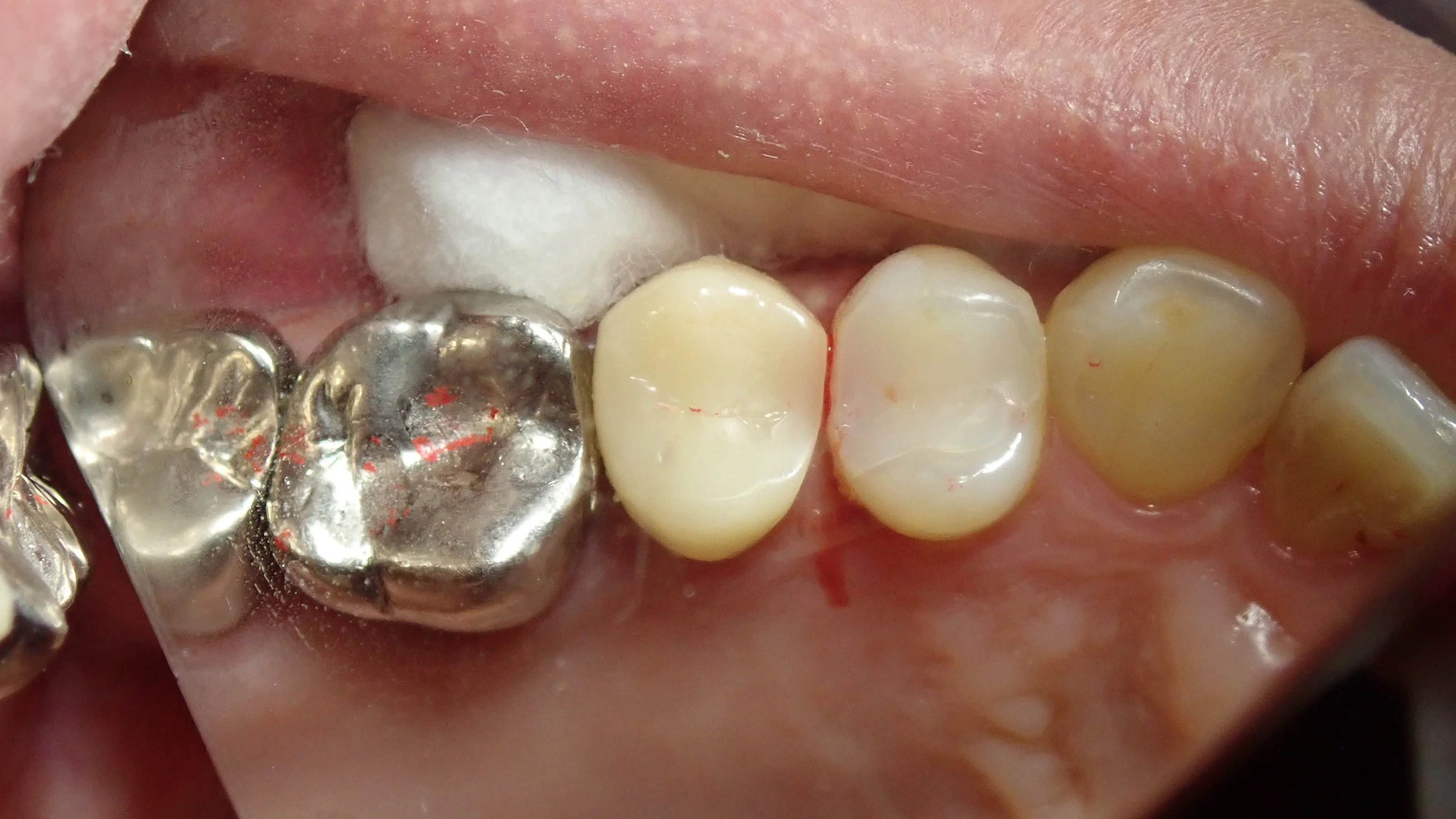 保険の白い被せ物｜坂寄歯科医院（取手市藤代） - 画像3