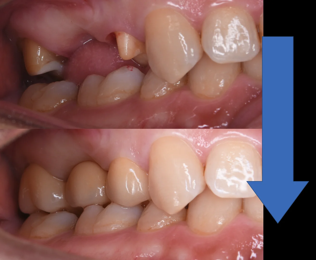 セラミックのブリッジ|坂寄歯科医院(取手市藤代) - 画像3