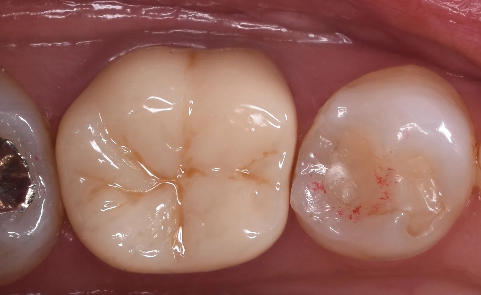 セラミックの被せ物｜坂寄歯科医院（取手市藤代） - 画像4