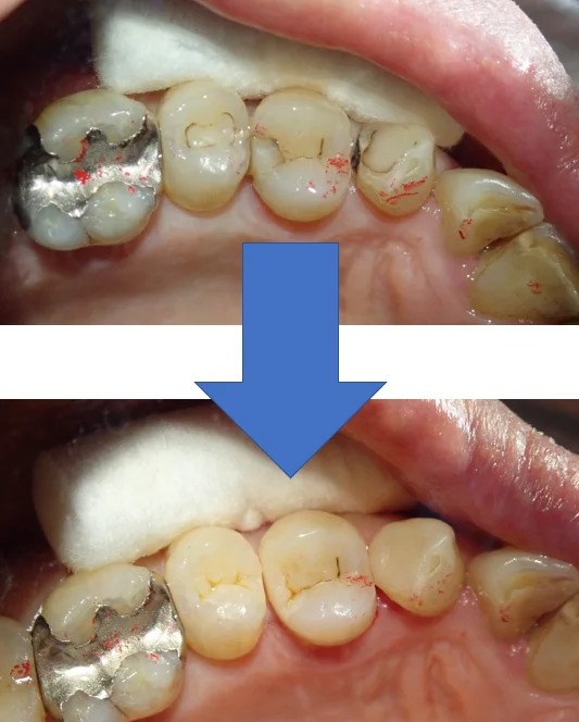 3本連続ダイレクトボンディング｜坂寄歯科医院（取手市藤代） - 画像4
