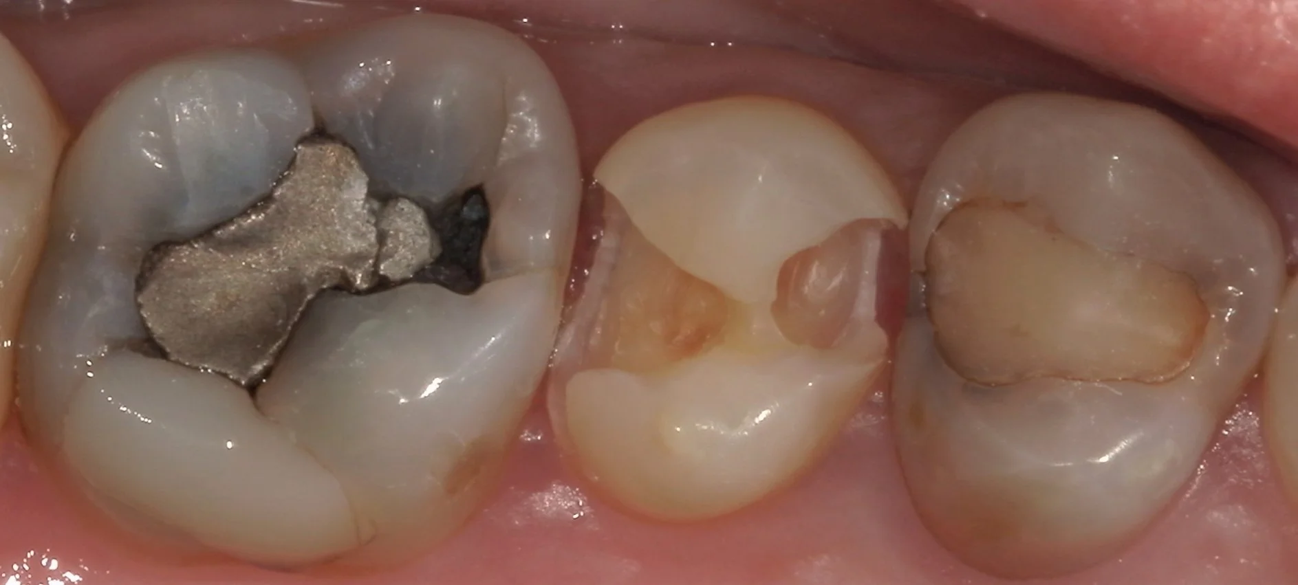 遠方から来院の方を白い詰め物にて治療。｜坂寄歯科医院（取手市藤代） - 画像3