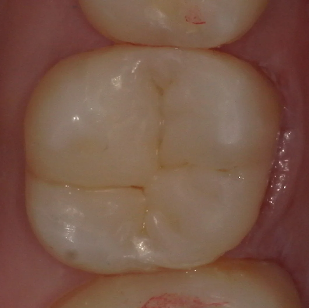 歯の側面も同時に治療したケース。｜坂寄歯科医院（取手市藤代） - 画像5
