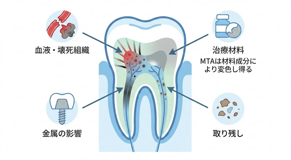 神経を取った歯（失活歯）が黒ずむ主な原因（血液や壊死組織の分解、根管治療材料の着色、金属コアの透け、髄室内の清掃不足）を模式図で解説するイラスト。気になる変色は原因が複数あり、歯科医院での診査が重要。