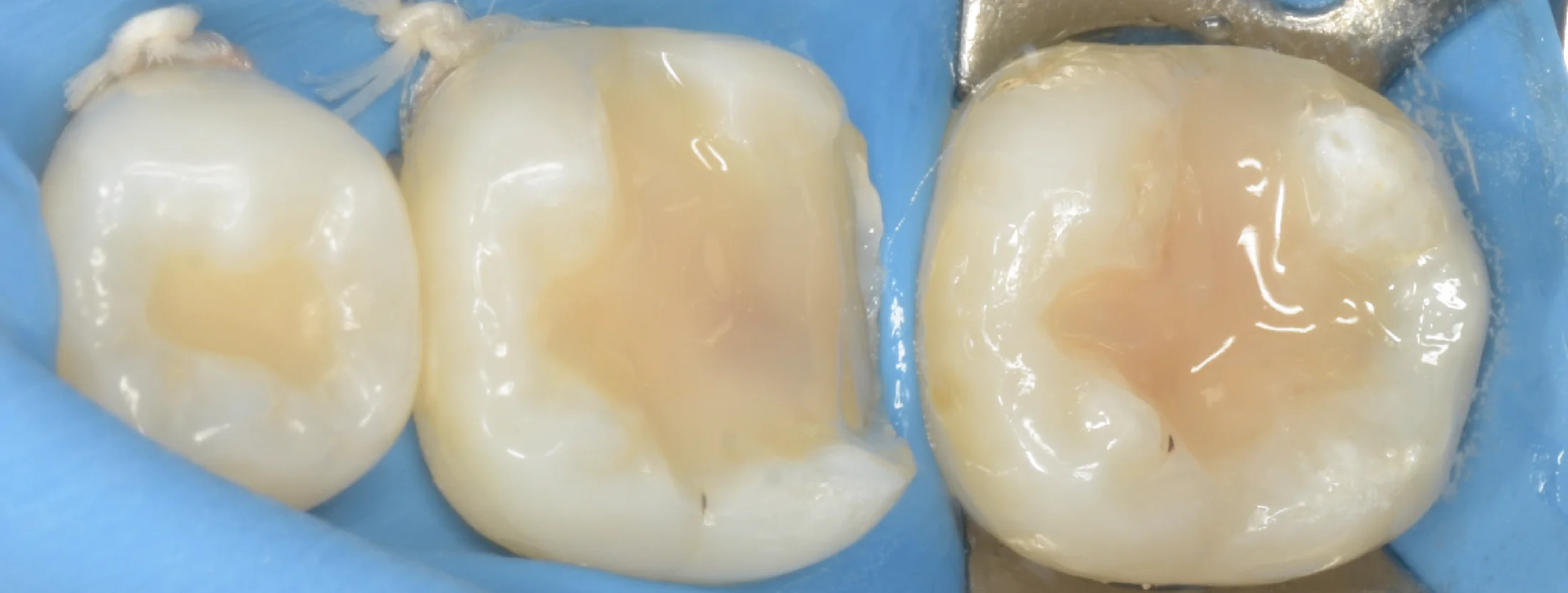 歯科医師の方のCAD/CAMインレーを治療。｜坂寄歯科医院（取手市藤代） - 画像5