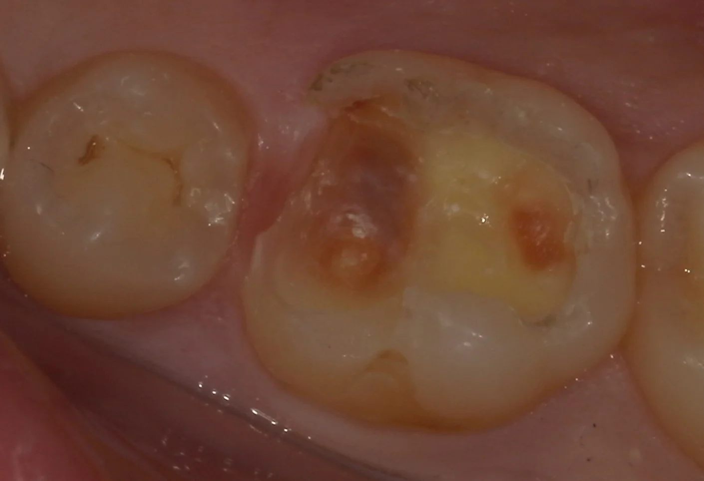 難易度の高い白い詰め物。｜坂寄歯科医院（取手市藤代） - 画像2