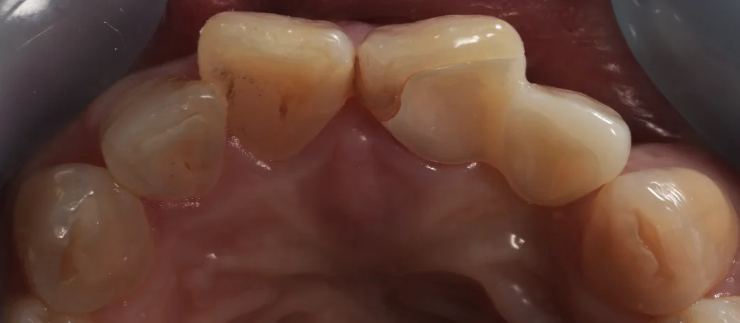 審美治療+歯質保存：延長セラミックブリッジ｜坂寄歯科医院（取手市藤代） - 画像4