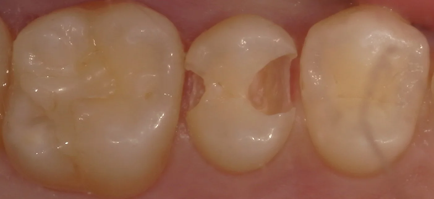 遠方から白い詰め物での治療を求めて・・・｜坂寄歯科医院（取手市藤代） - 画像4