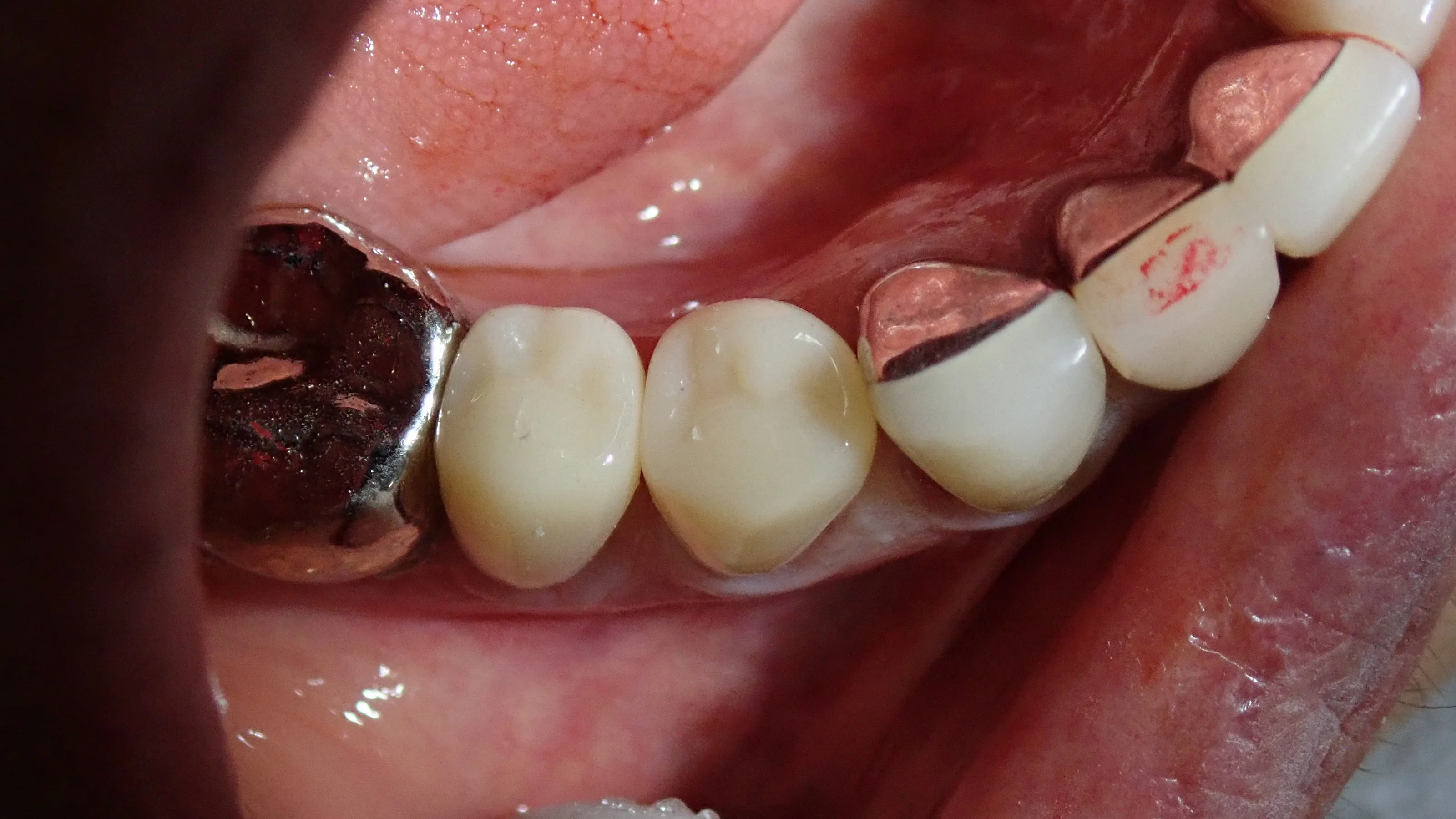 CAD/CAM冠について｜坂寄歯科医院（取手市藤代） - 画像3