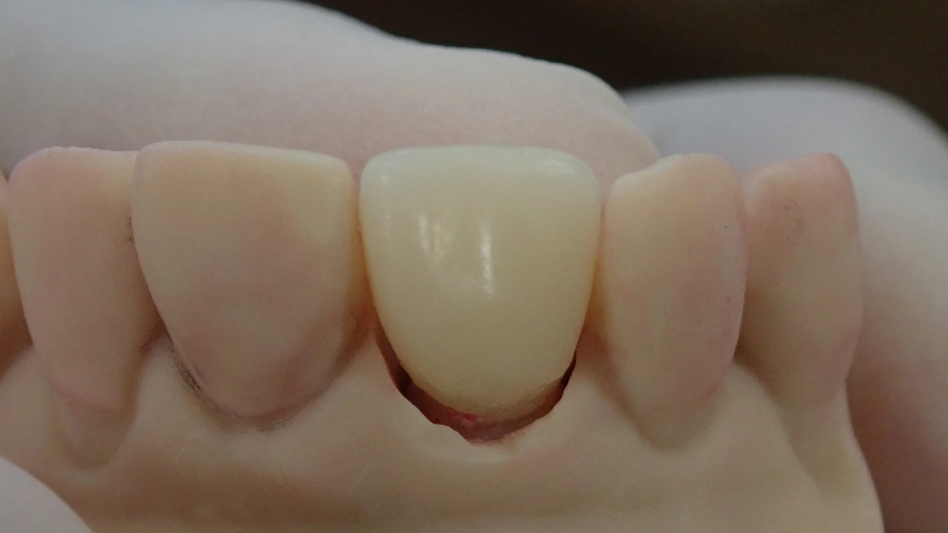 仮歯へのこだわり。その２｜坂寄歯科医院（取手市藤代） - 画像4