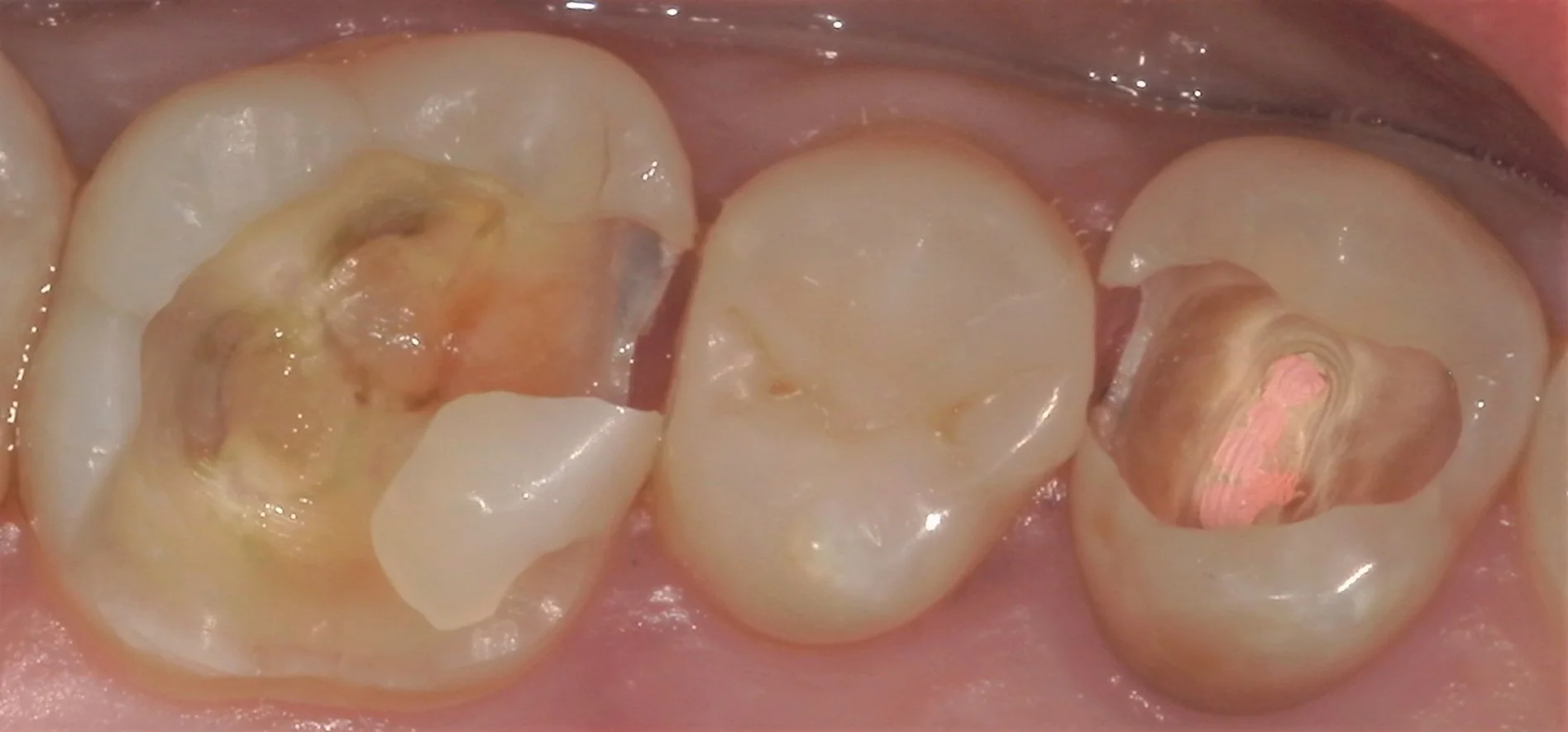 遠方から来院の方を白い詰め物にて治療。｜坂寄歯科医院（取手市藤代） - 画像6