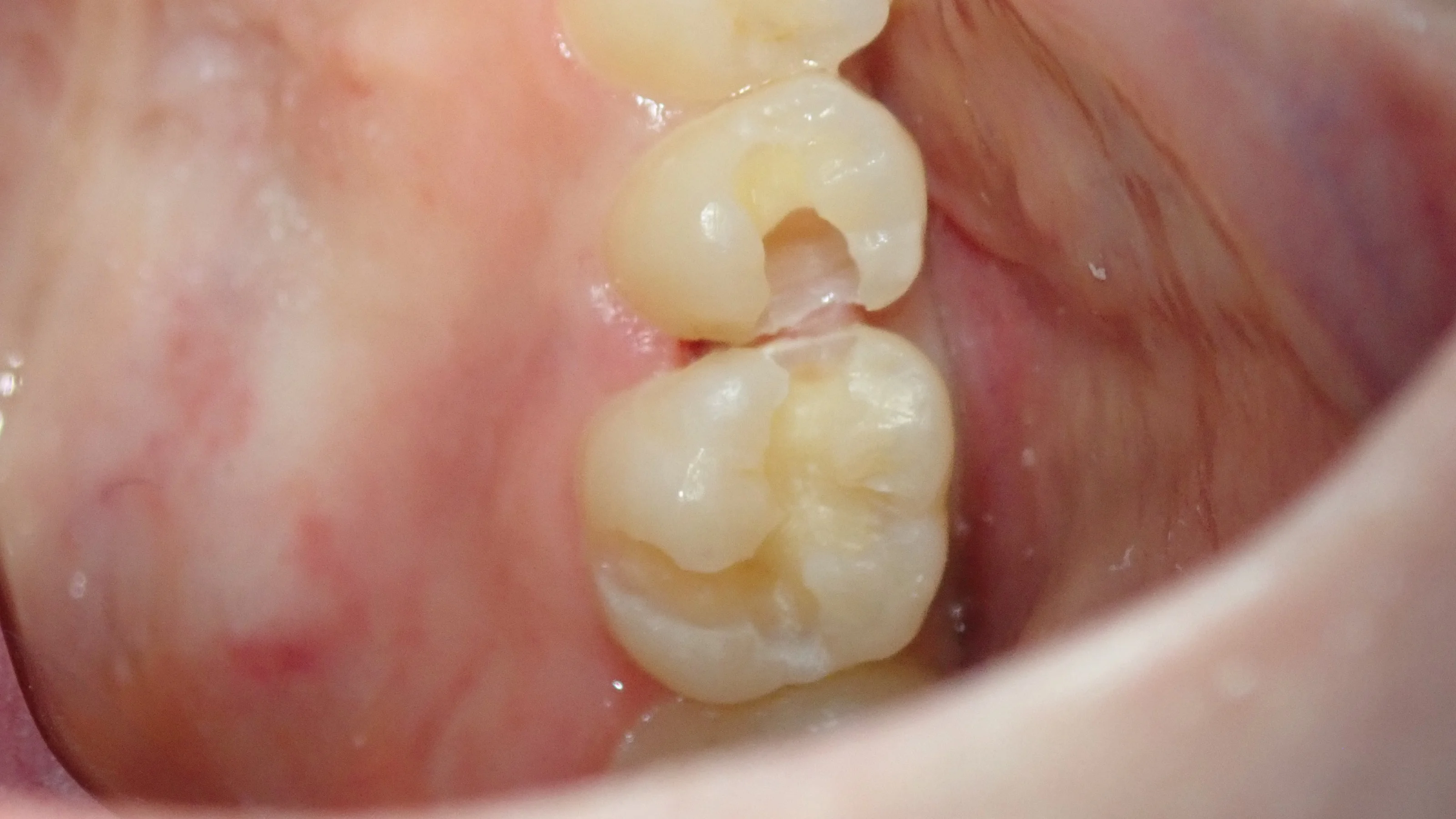 コンポジットレジン②|坂寄歯科医院(取手市藤代) - 画像3