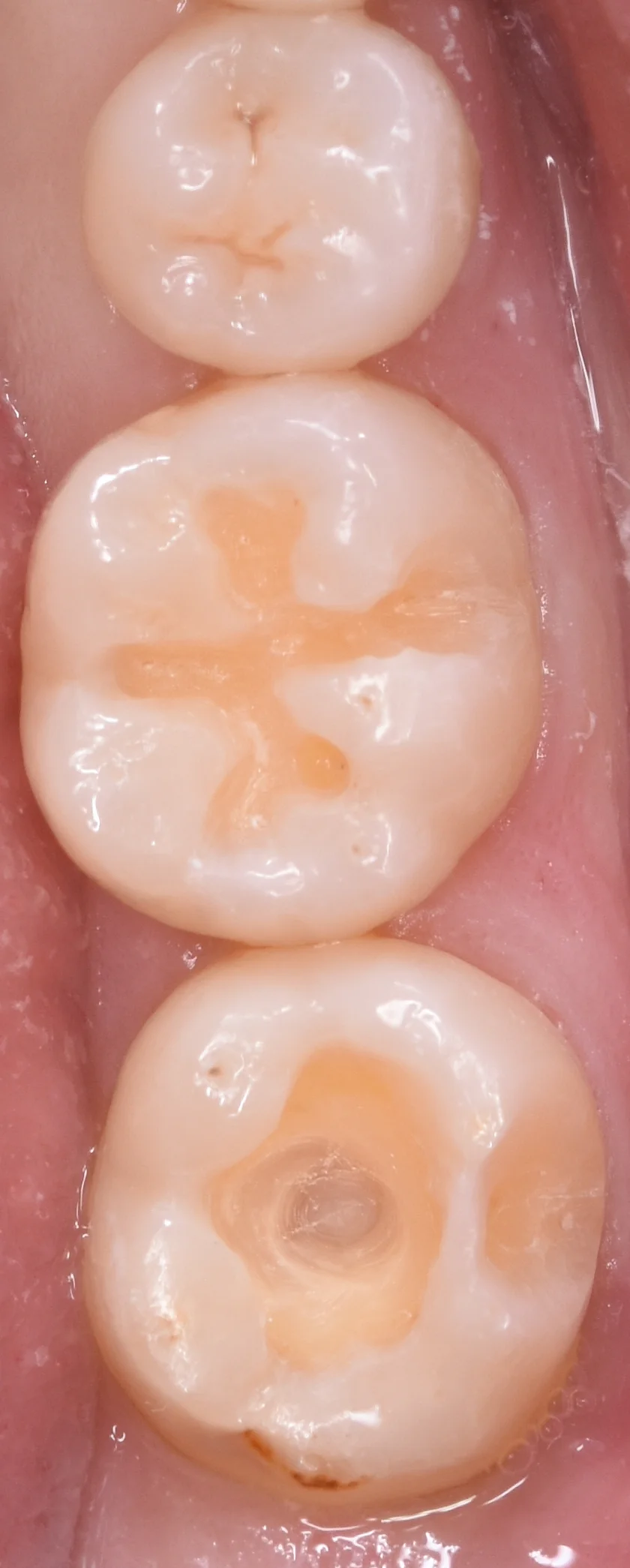 他県にて勤務中の歯科衛生士の方の治療。｜坂寄歯科医院（取手市藤代） - 画像3