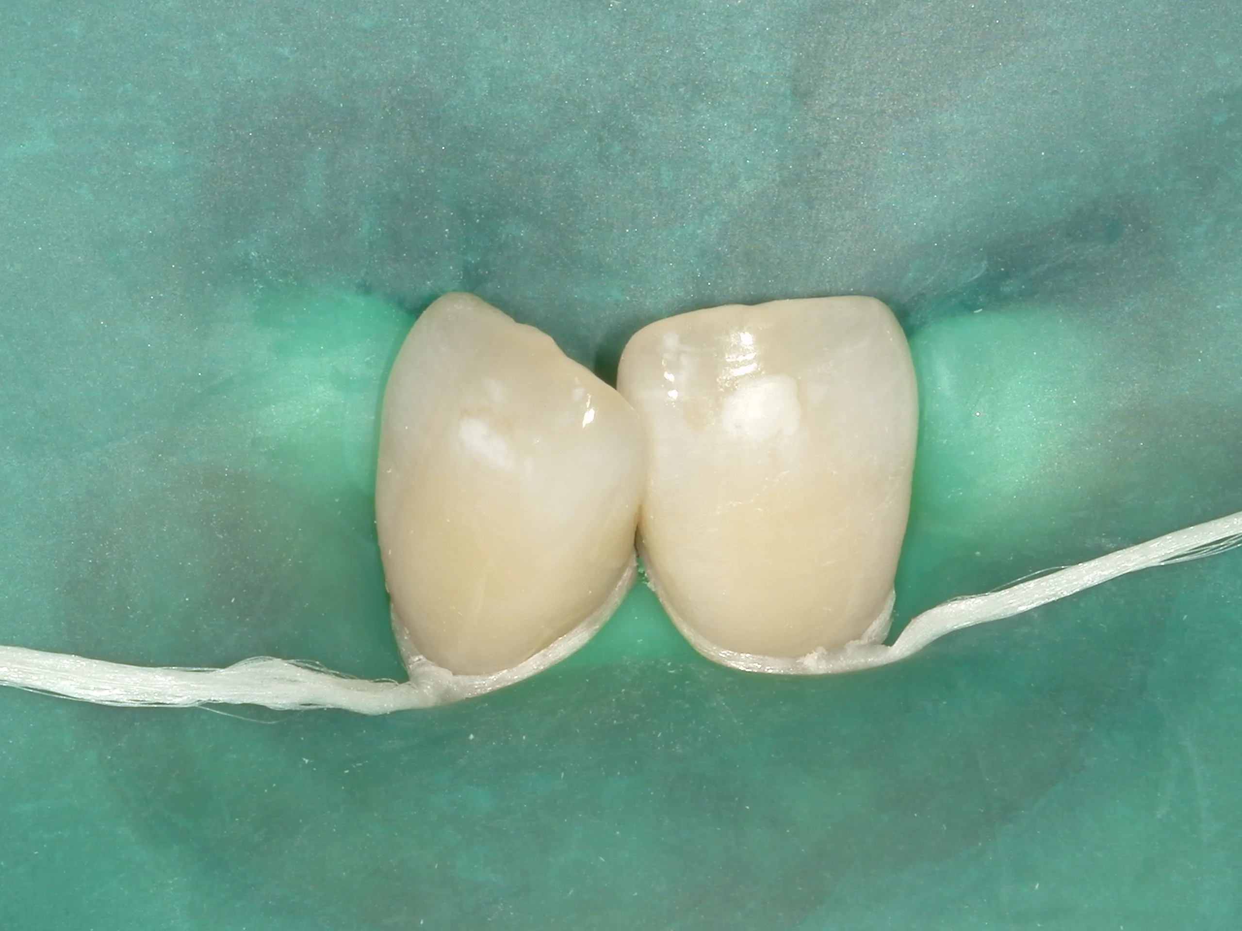 ICON治療(低侵襲ホワイトスポット改善治療)を始めました。|坂寄歯科医院(取手市藤代) - 画像3