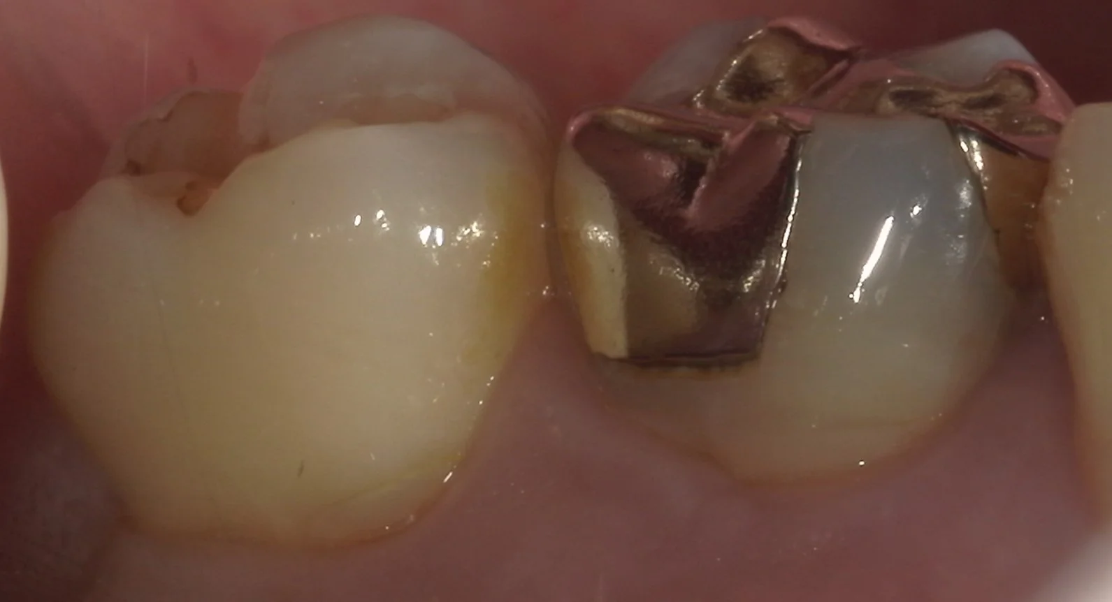 歯の側面も同時に治療したケース。｜坂寄歯科医院（取手市藤代） - 画像2