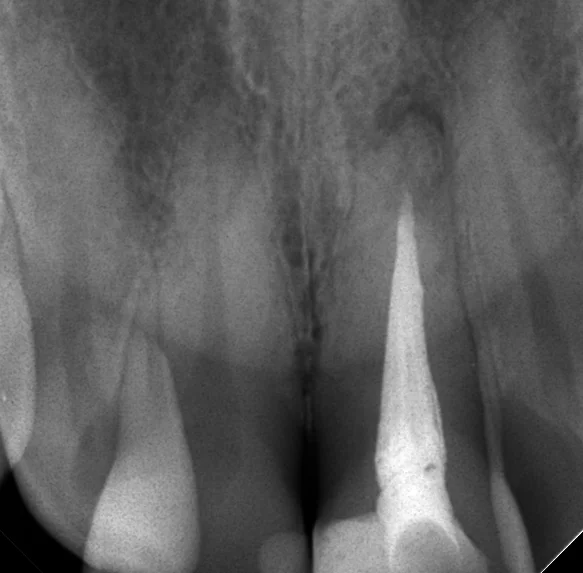 前歯の根管治療｜坂寄歯科医院（取手市藤代） - 画像3