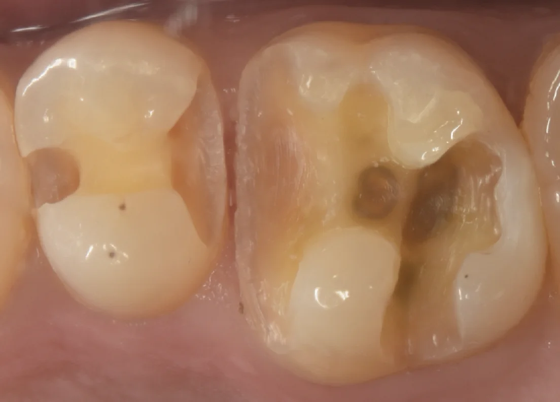 金属の詰め物を白い詰め物に。｜坂寄歯科医院（取手市藤代） - 画像2