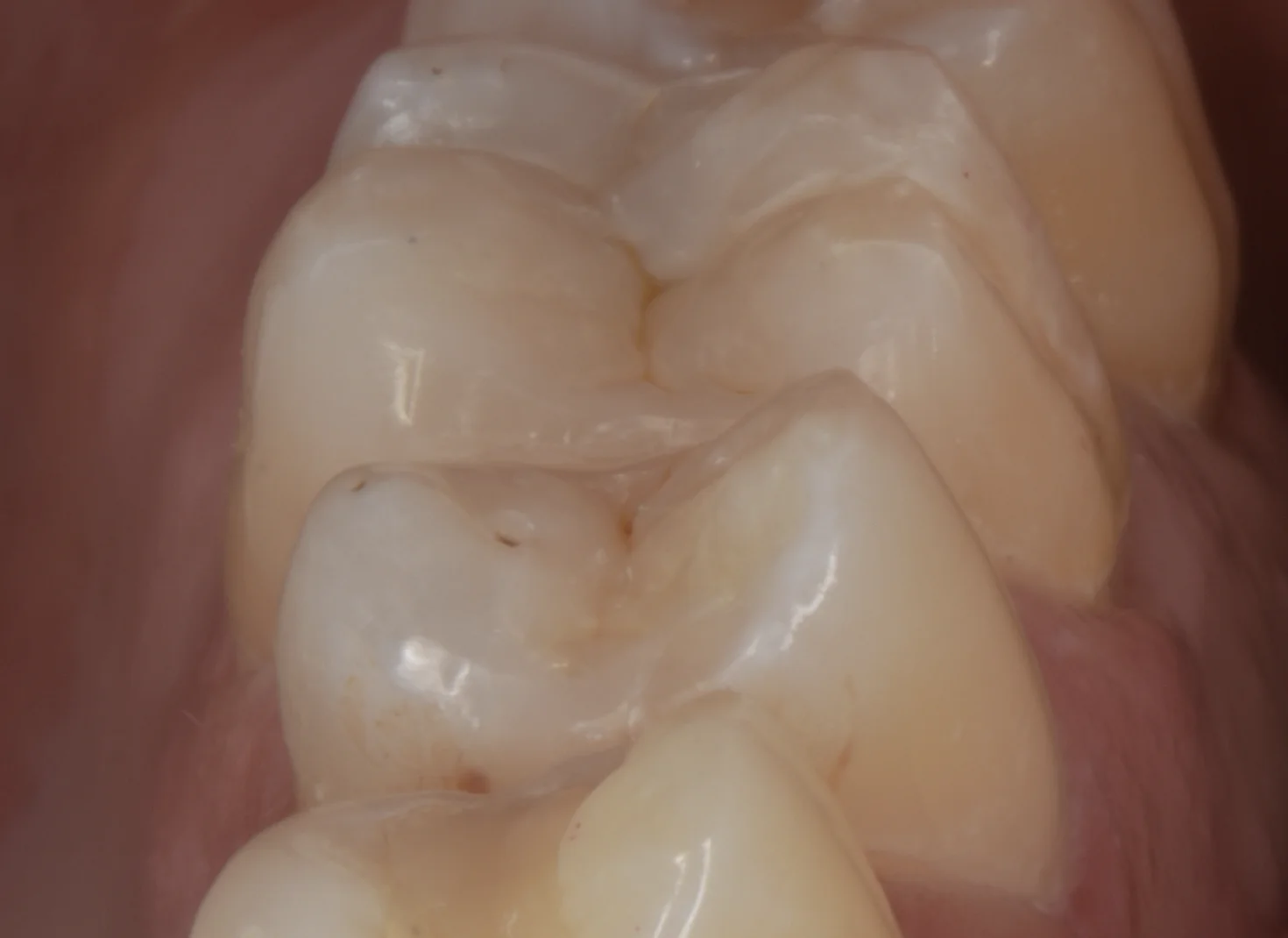 金属の詰め物を白い詰め物に。｜坂寄歯科医院（取手市藤代） - 画像4